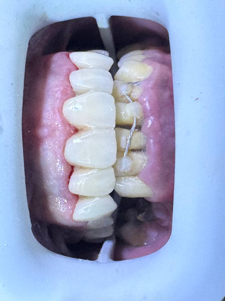 بعد العلاج — ابتسامة مثالية