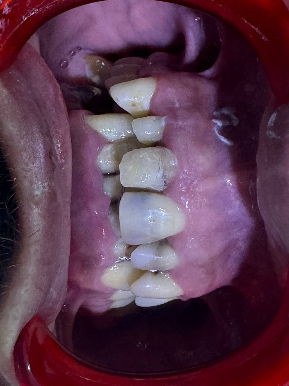 قبل العلاج — أسنان تالفة