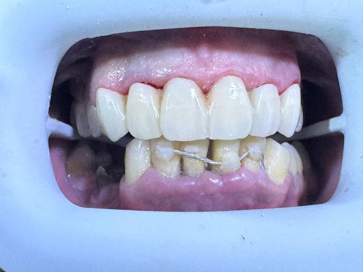 بعد العلاج — حالة حقيقية · تيجان الزركون Arzee Dental Sétif