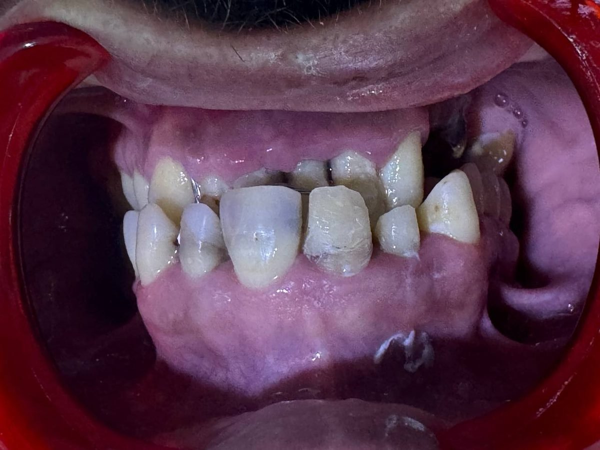 قبل العلاج — حالة حقيقية · تيجان الزركون Arzee Dental Sétif