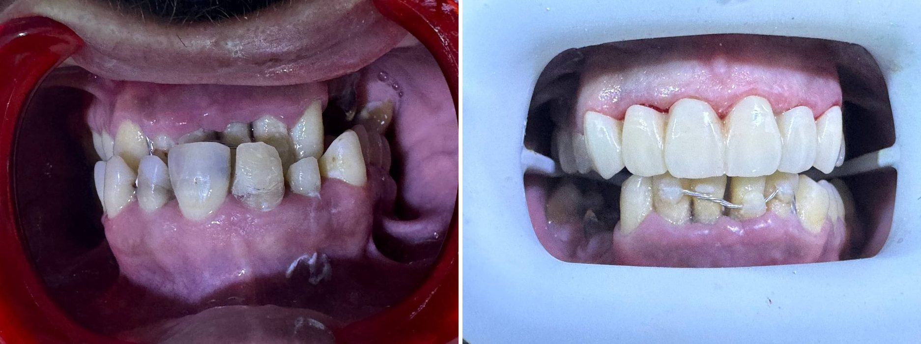 حالة حقيقية · تيجان الزركون — Arzee Dental Sétif
