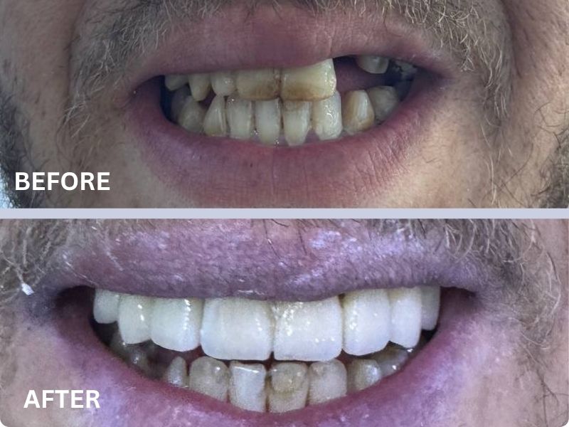 Couronnes Zirconium - Avant/Après