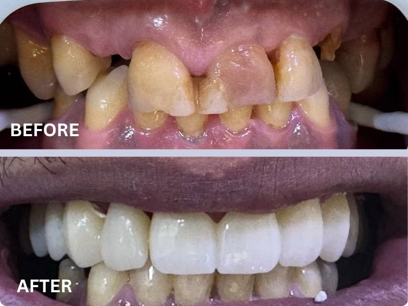 Couronnes Zirconium - Avant/Après